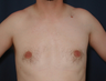 Gynecomatia correction