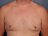 Gynecomastia correction with periareolar reduction