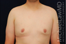 Gynecomastia
