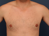 Gynecomastia Correction 