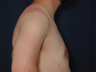 Gynecomastia Correction