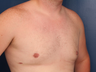Gynecomastia Correction 