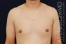 Gynecomastia