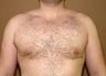 Gynecomastia correction  (male breast correction)