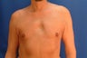 50 year old gnecomastio correction 