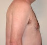 Before and After Treatment of Gynecomastia With Liposuction (Side View)