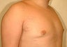 Treatment of Gynecomastia (male enlarged breasts)