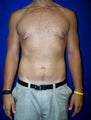 Gynecomastia