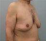 Male Chest Reduction