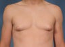 Male Breast Reduction