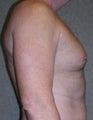 Male Breast Reduction (Gynecomastia)