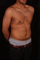 Male Breast Reduction