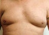 Gynecomastia and Power Assisted Liposuction