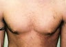 Gynecomastia and Power Assisted Liposuction