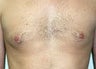 Gynecomastia and Power Assisted Liposuction