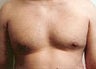 Gynecomastia and Power Assisted Liposuction