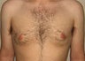 Gynecomastia and Power Assisted Liposuction