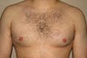 Gynecomastia and Power Assisted Liposuction