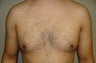 Gynecomastia and Power Assisted Liposuction