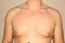 Gynecomastia and Power Assisted Liposuction