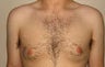 Gynecomastia and Power Assisted Liposuction