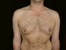 Gynecomastia Reduction Surgery