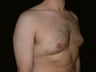 Gynecomastia Reduction Surgery
