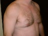 Gynecomastia Reduction Surgery