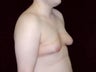 Gynecomastia Reduction Surgery