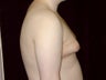 Gynecomastia Reduction Surgery