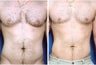 Male Breast Reduction Using Liposuction