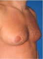 Male Breast Reduction