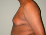 Gynecomastia