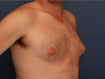 Gynecomastia correction