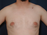 Gynecomatia correction
