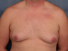 Gynecomastia correction with periareolar reduction