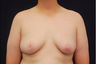 Gynecomastia
