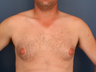 Gynecomastia Correction 
