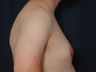 Gynecomastia Correction