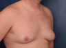 Gynecomastia Correction 