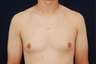 Gynecomastia