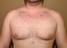 Gynecomastia correction  (male breast correction)