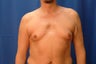 50 year old gnecomastio correction 