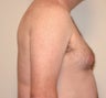 Before and After Treatment of Gynecomastia With Liposuction (Side View)