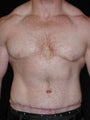 Male Tummy Tuck, Flank Liposuction, Male Breast Reduction