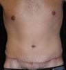 Male tummy Tuck, Flank Liposuction