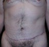 Male tummy Tuck
