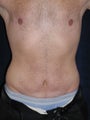 Male Tummy Tuck, Flank Liposuction, Male Breast Reduction
