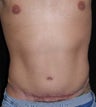 Male tummy Tuck, Flank Liposuction