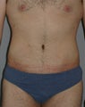 Male Abdominoplasty